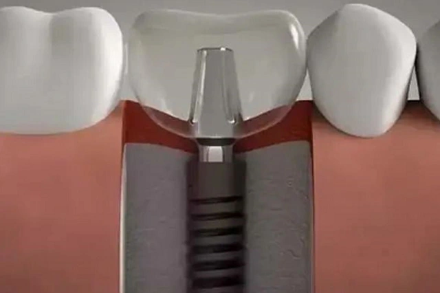 titanium tooth implant price