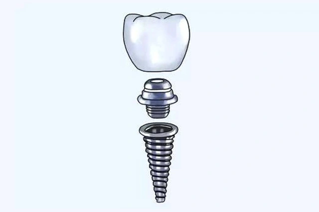 titanium tooth implant stock for sale