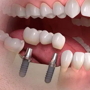 custom titanium dental implants stock