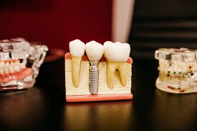 titanium tooth implant